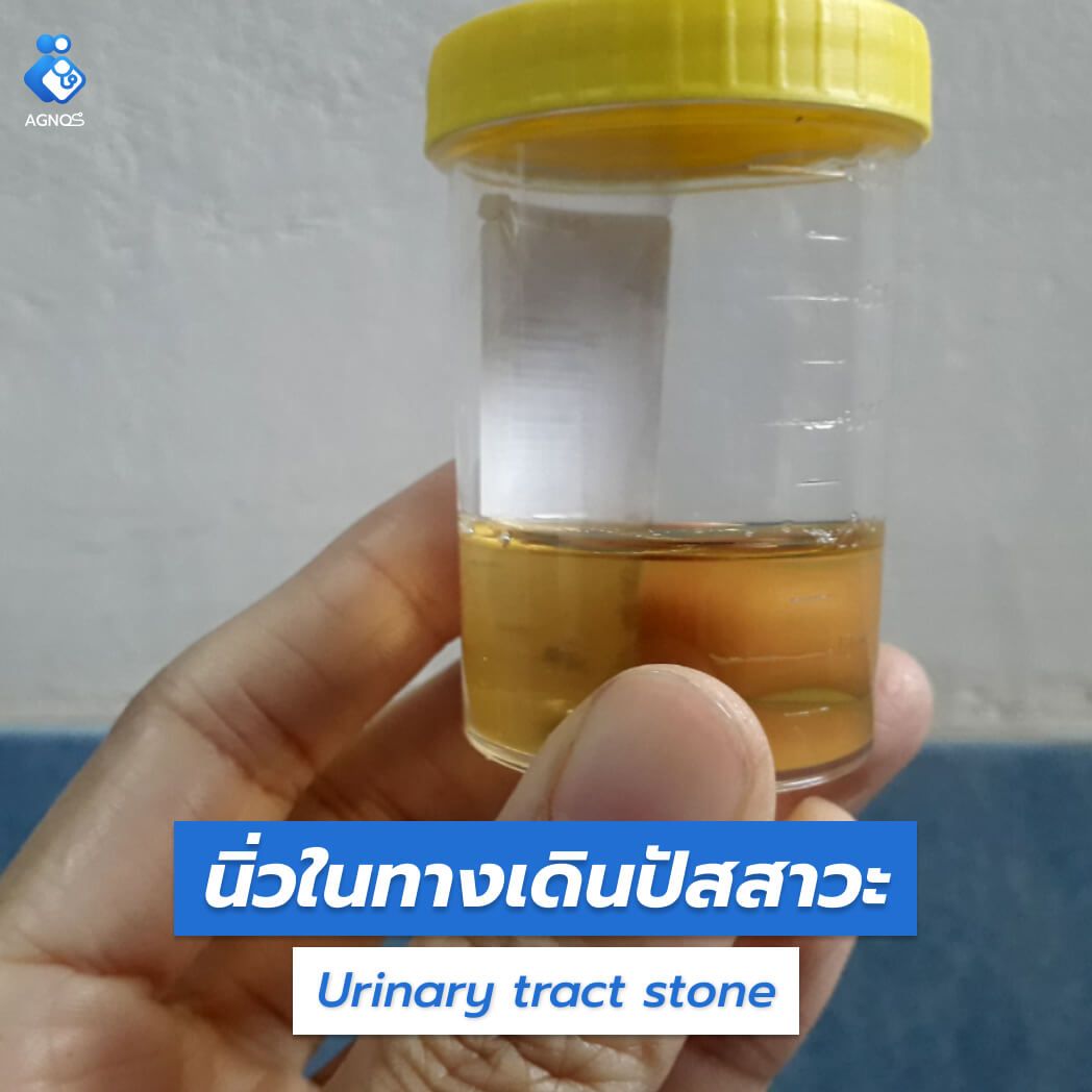 นิ่วในทางเดินปัสสาวะ (Urinary
tract stone)