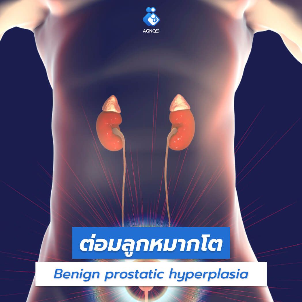 ต่อมลูกหมากโต (Benign
prostatic hyperplasia)