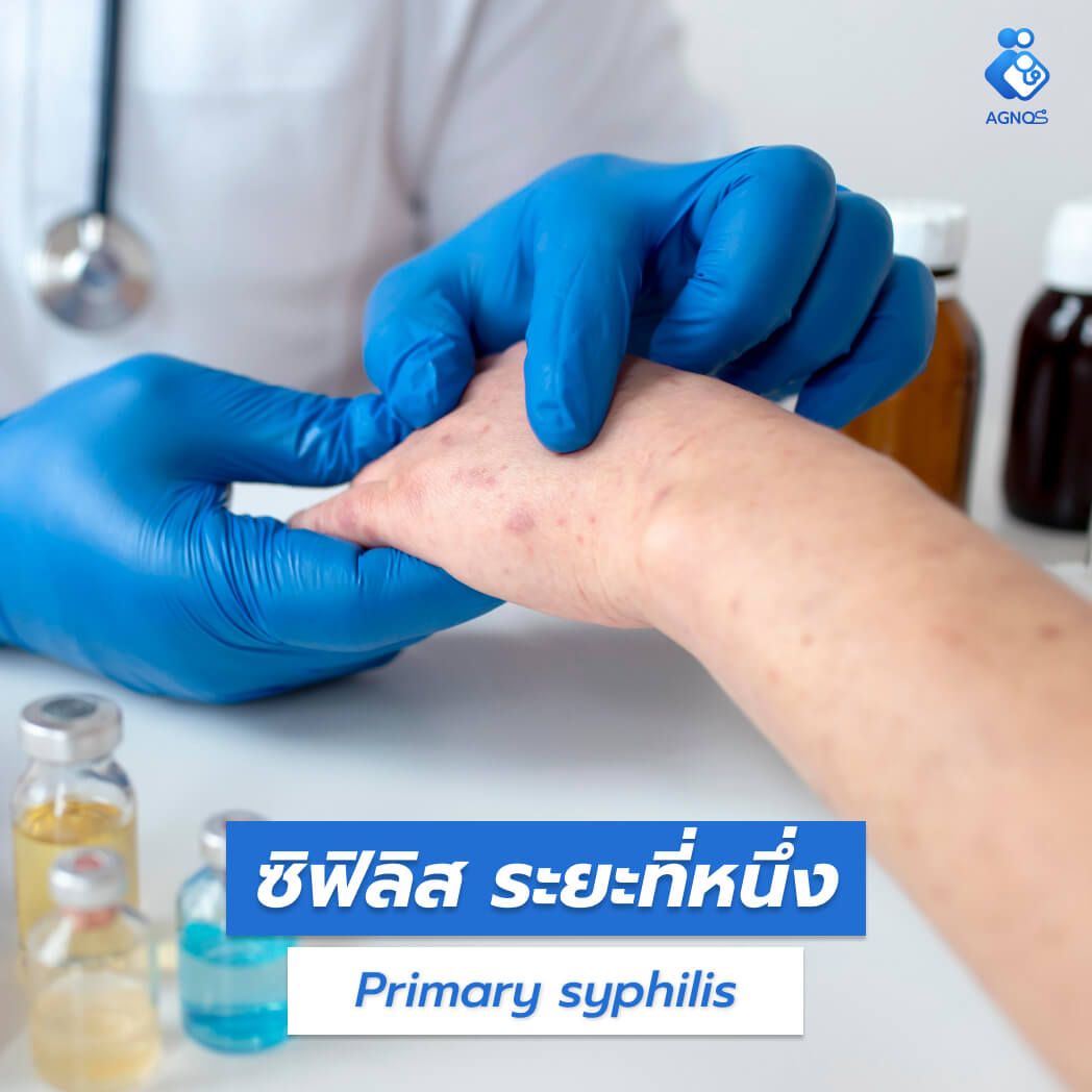 ซิฟิลิส ระยะที่หนึ่ง (Primary
syphilis)