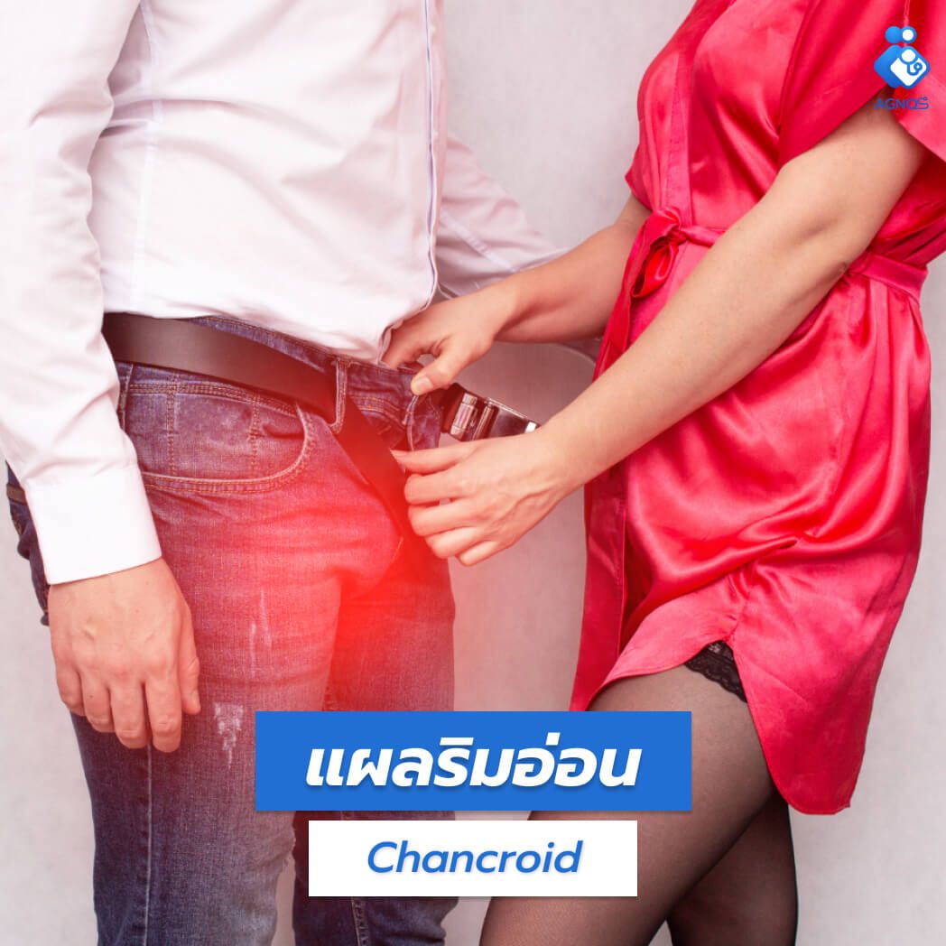 แผลริมอ่อน (Chancroid)