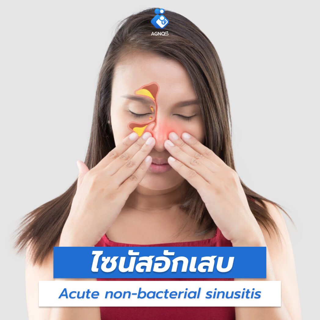 ไซนัสอักเสบ (Acute
non-bacterial sinusitis)