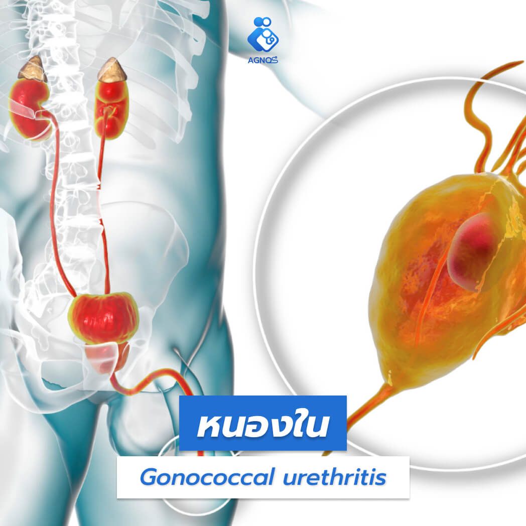 หนองใน (Gonococcal
urethritis)