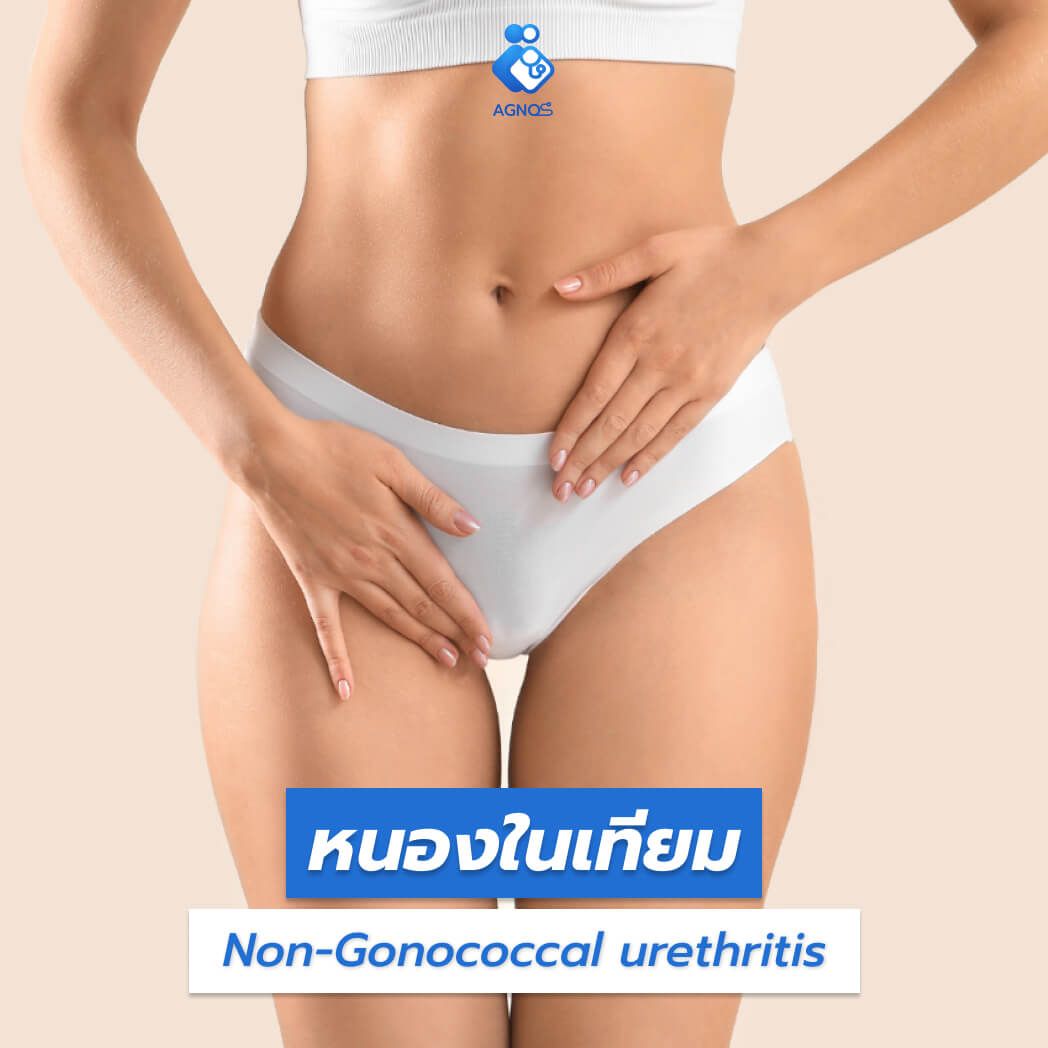 หนองในเทียม (Non-Gonococcal
    urethritis)