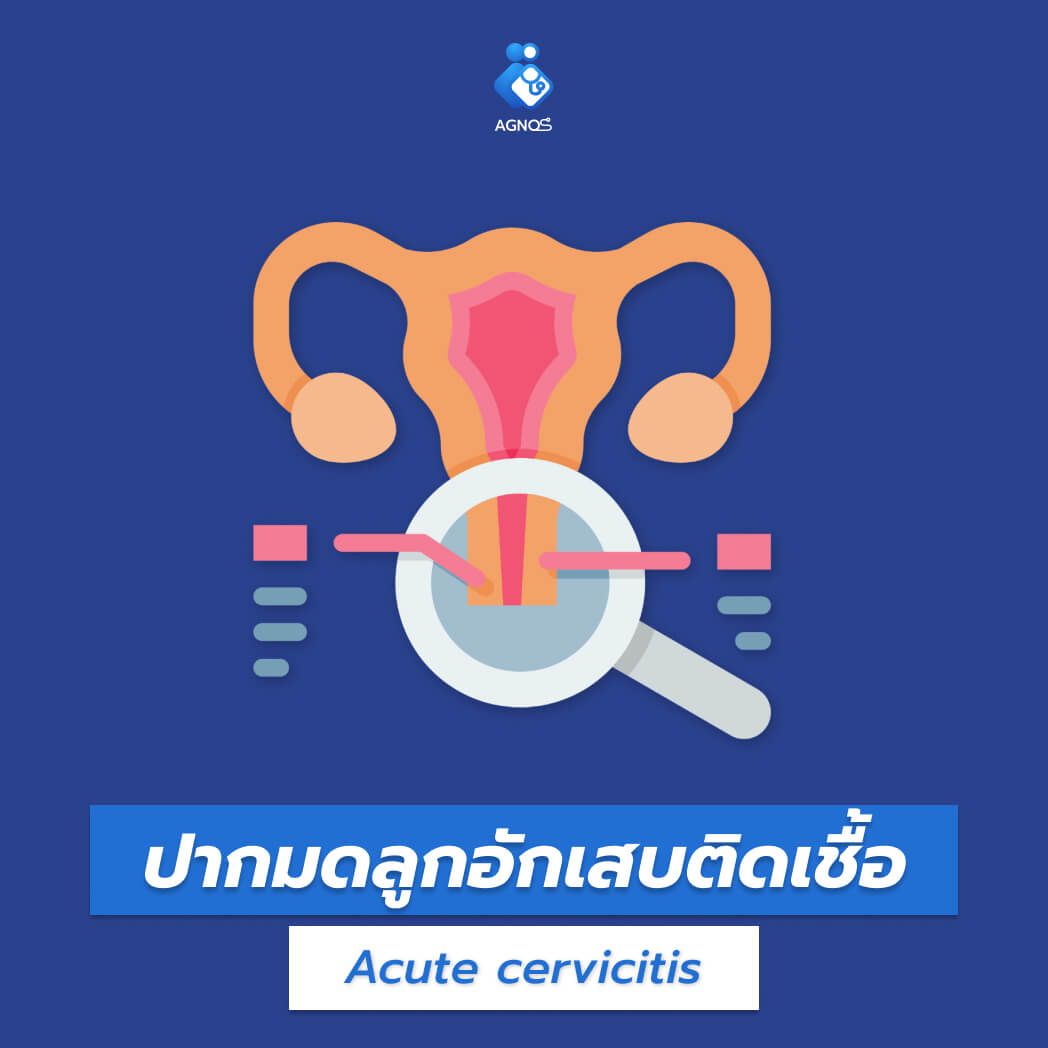 ปากมดลูกอักเสบติดเชื้อ (Acute
cervicitis)