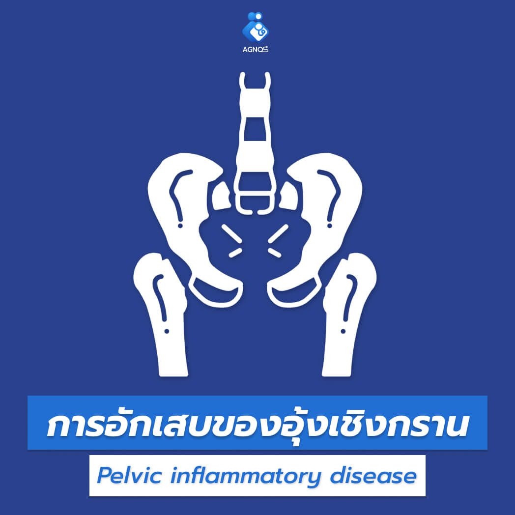การอักเสบของอุ้งเชิงกราน
(Pelvic inflammatory disease)