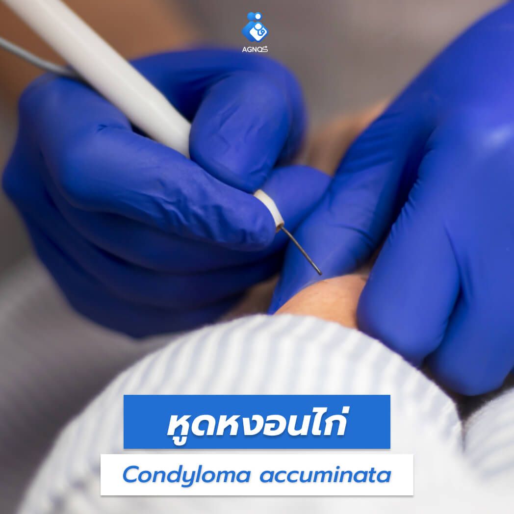 หูดหงอนไก่ (Condyloma
    accuminata)