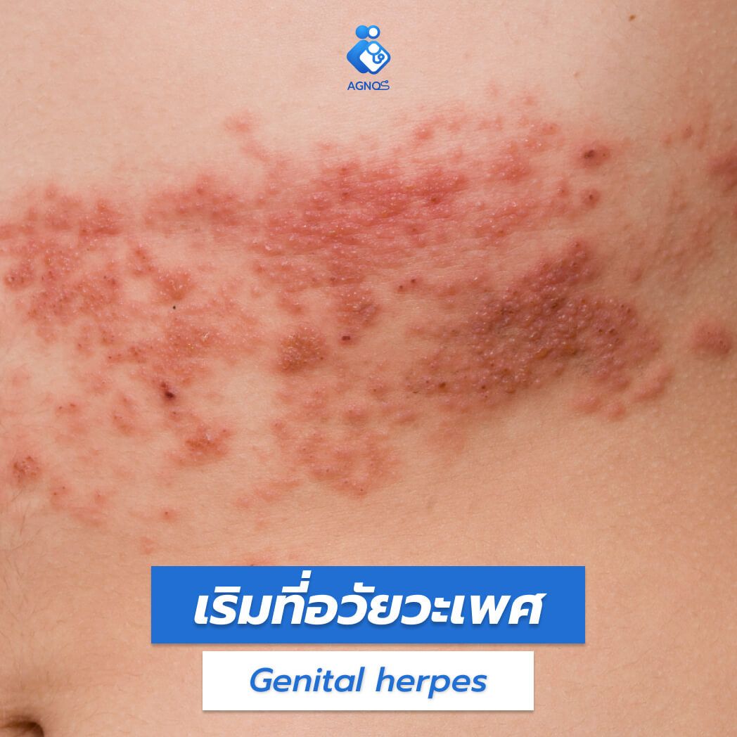 เริมที่อวัยวะเพศ (Genital herpes)