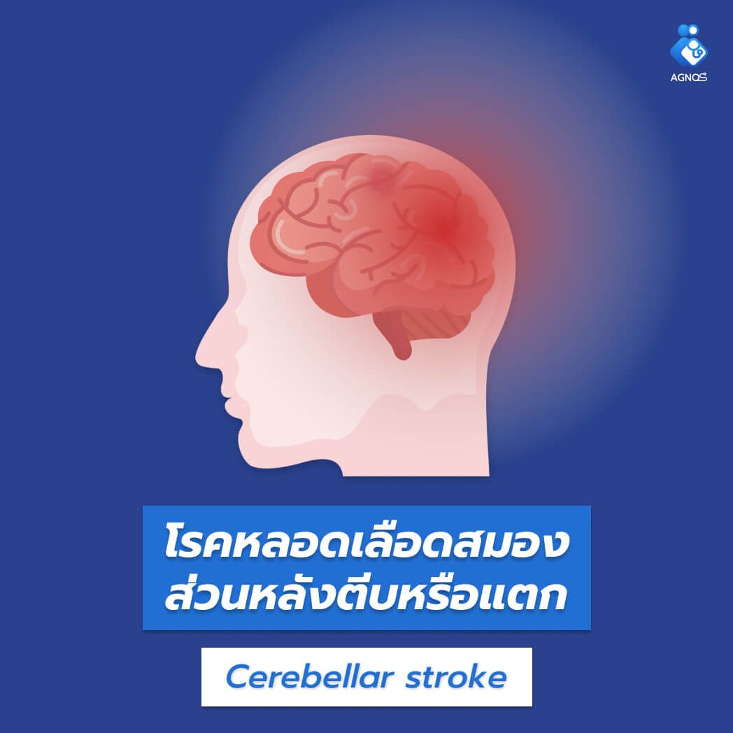โรคหลอดเลือดสมองส่วนหลังตีบหรือแตก
(Cerebellar stroke)