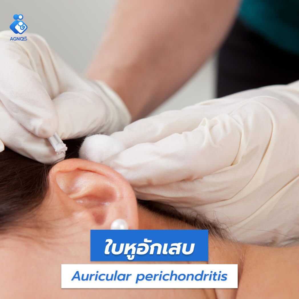 ใบหูอักเสบ (Auricular
perichondritis)
