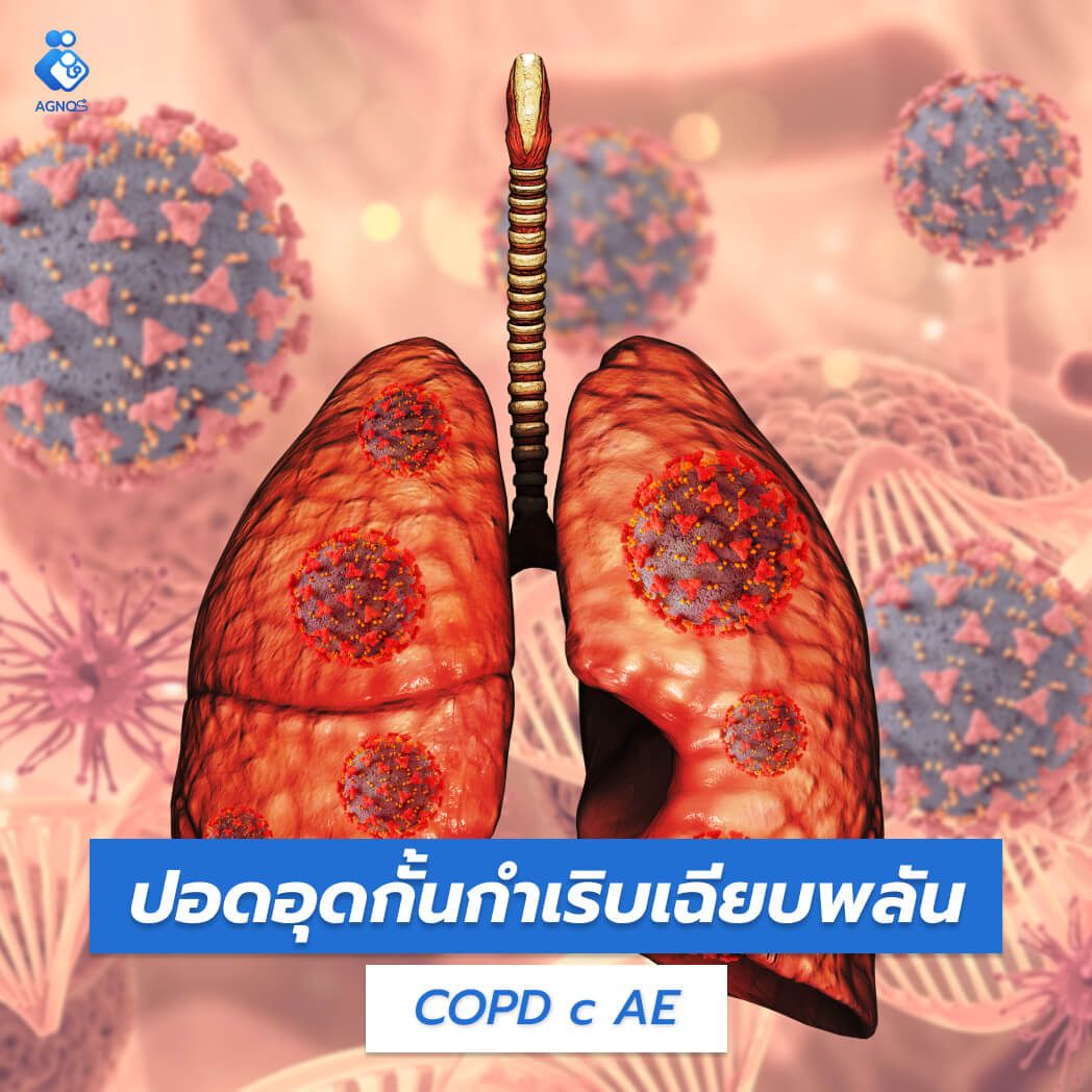 ปอดอุดกั้นกำเริบเฉียบพลัน
(COPD with Acute Exacerbation)