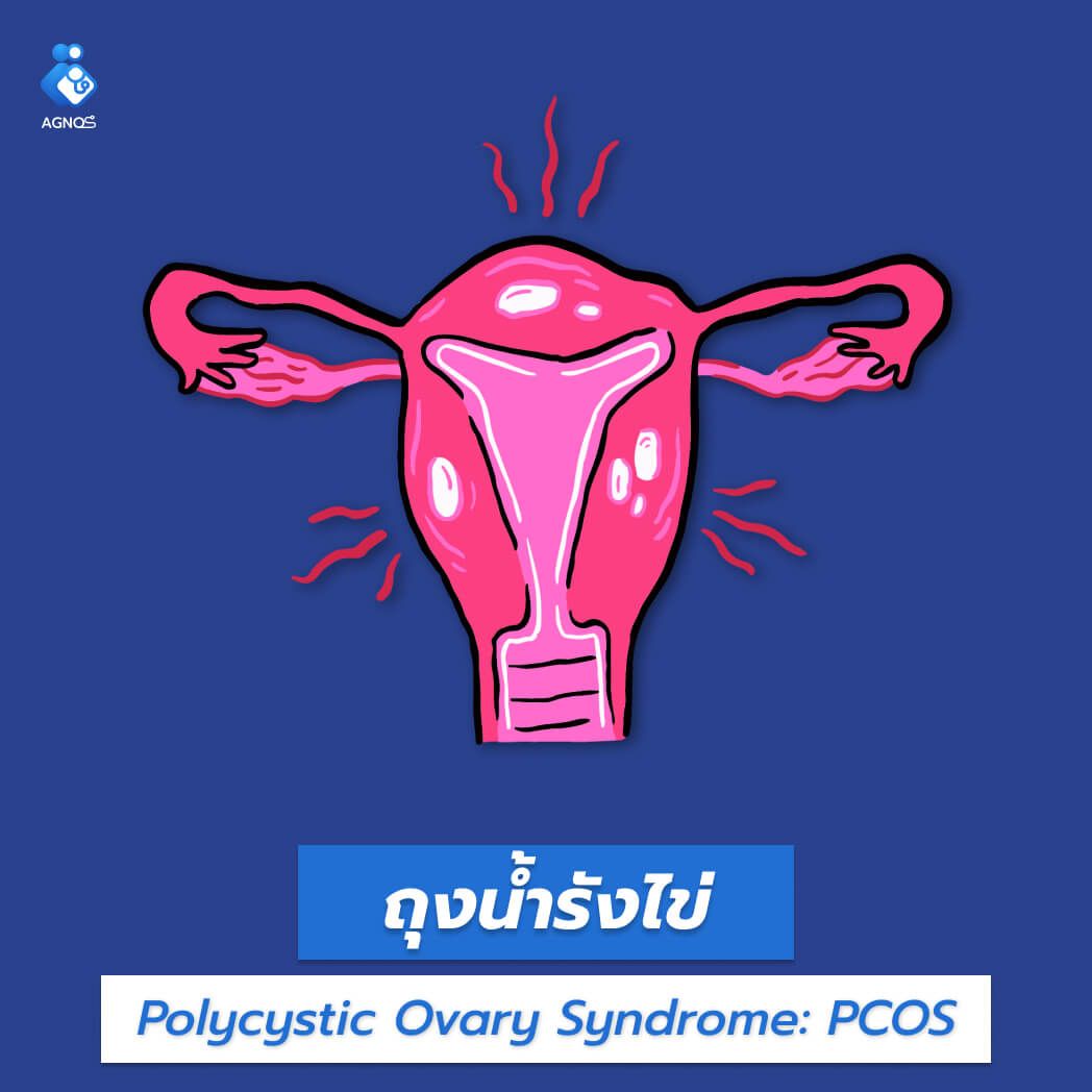 ถุงน้ำรังไข่ (PCOS)