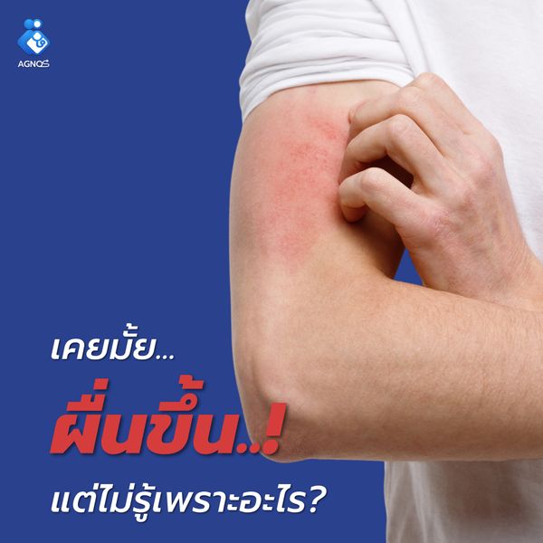 เคยไหม..อยู่ดีๆ ก็ ผื่นขึ้น!