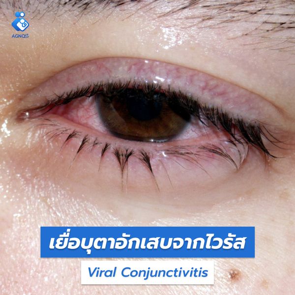 เยื่อบุตาอักเสบจากไวรัส
(Viral Conjunctivitis)
