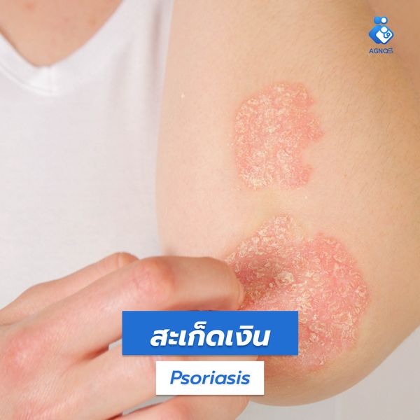 สะเก็ดเงิน (Psoriasis)