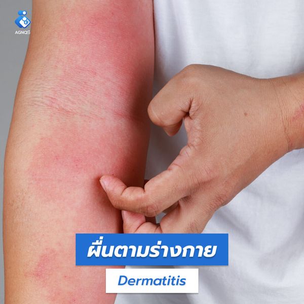 ผื่นตามร่างกาย (Rash
unspecified)