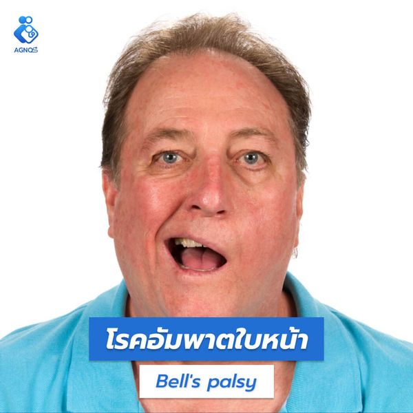 โรคอัมพาตใบหน้า (Bell's palsy)
