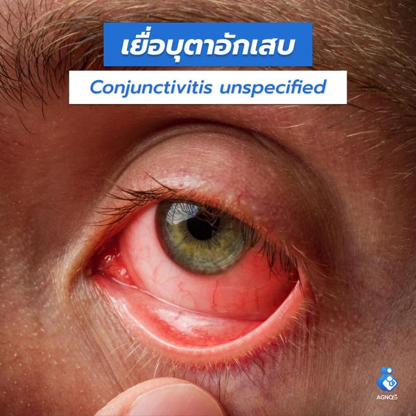 เยื่อบุตาอักเสบ
(Conjunctivitis unspecified)