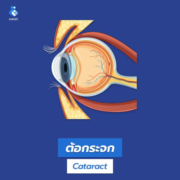 ต้อกระจก (Cataract)