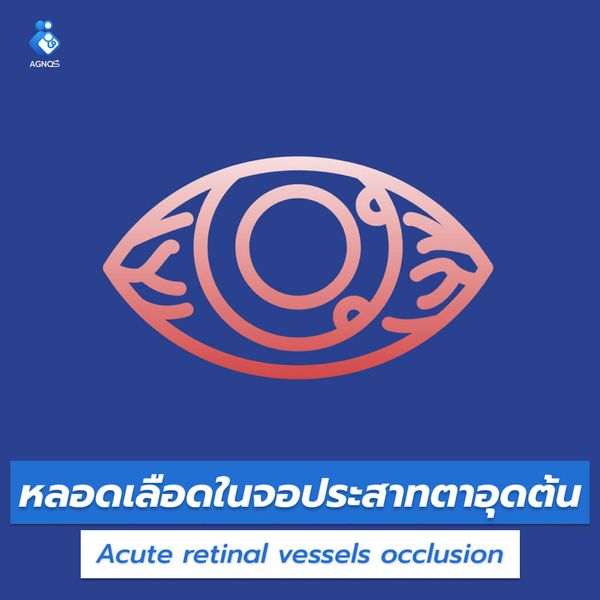 หลอดเลือดในจอประสาทตาอุดตัน
(Acute retinal vessels occlusion)