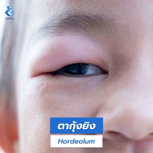 ตากุ้งยิง (Hordeolum)