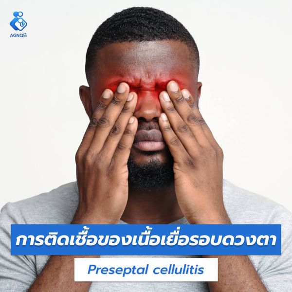 การติดเชื้อของเนื้อเยื่อรอบดวงตา
(Preseptal cellulitis)