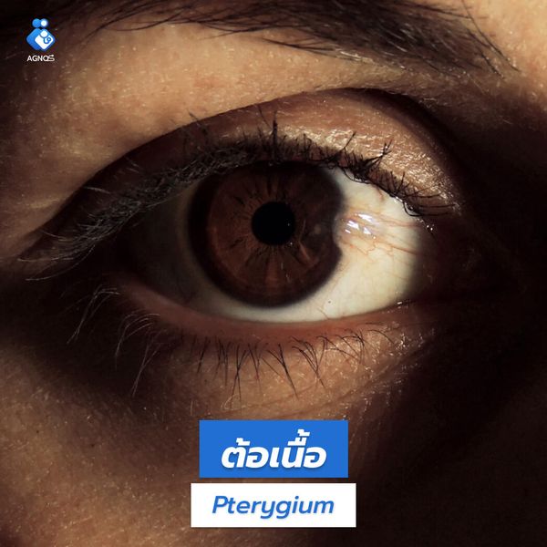 ต้อเนื้อ (Pterygium)