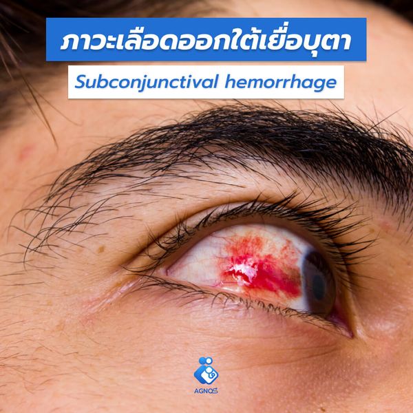 ภาวะเลือดออกใต้เยื่อบุตา
(Subconjunctival hemorrhage)