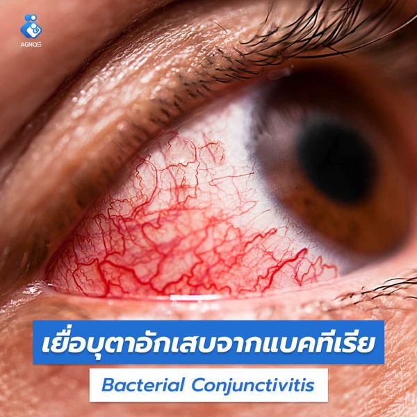 เยื่อบุตาอักเสบจากแบคทีเรีย
(Bacterial Conjunctivitis)