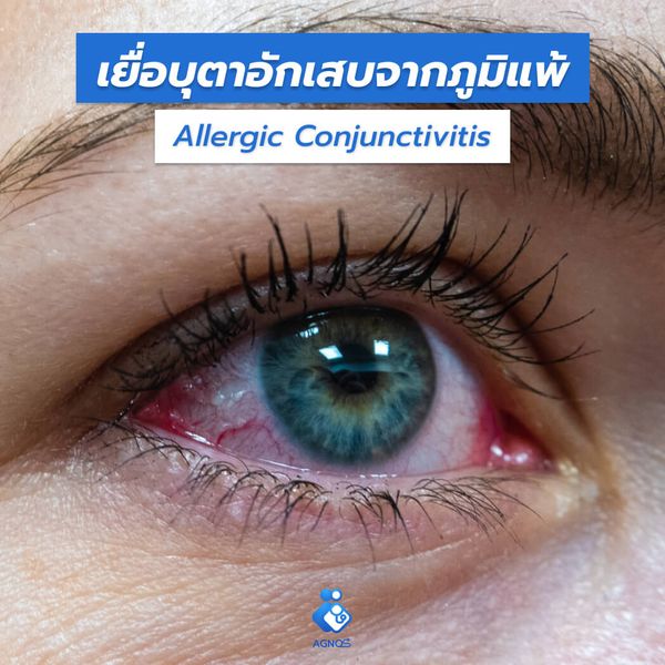 เยื่อบุตาอักเสบจากภูมิแพ้
(Allergic Conjuctivitis)