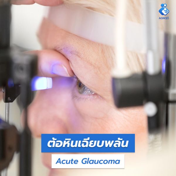 ต้อหินเฉียบพลัน (Acute Glaucoma)