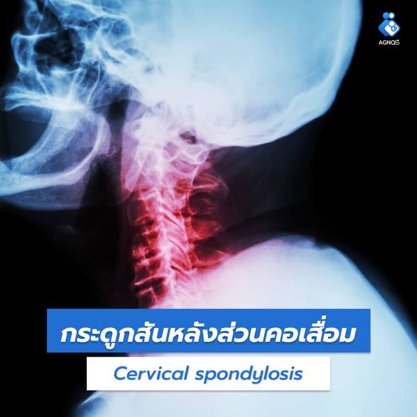กระดูกสันหลังส่วนคอเสื่อม
(Cervical spondylosis)