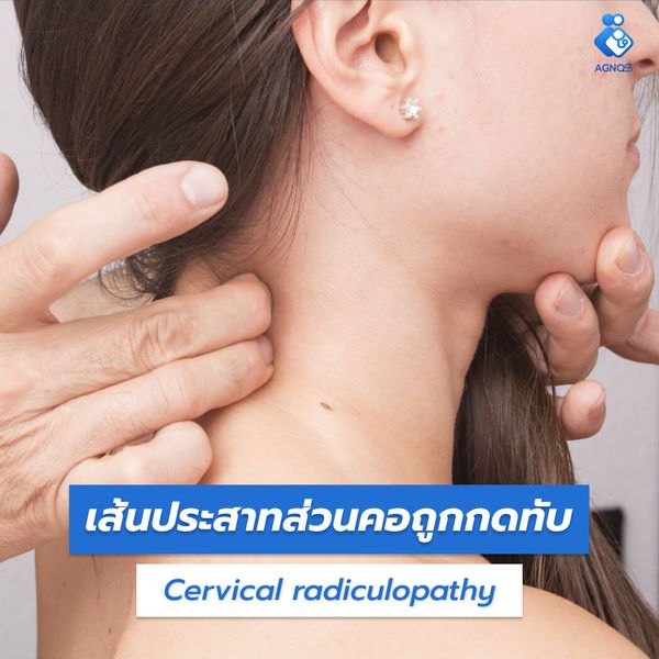 เส้นประสาทส่วนคอถูกกดทับ
(Cervical radiculopathy)