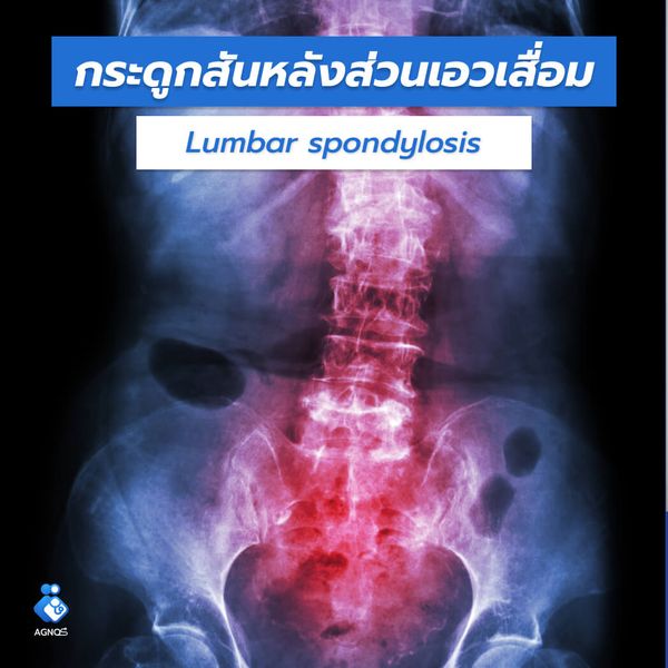 กระดูกสันหลังส่วนเอวเสื่อม
(Lumbar spondylosis)