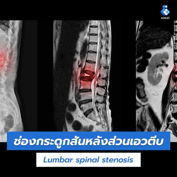 ช่องกระดูกสันหลังส่วนเอวตีบ
(Lumbar spinal stenosis)