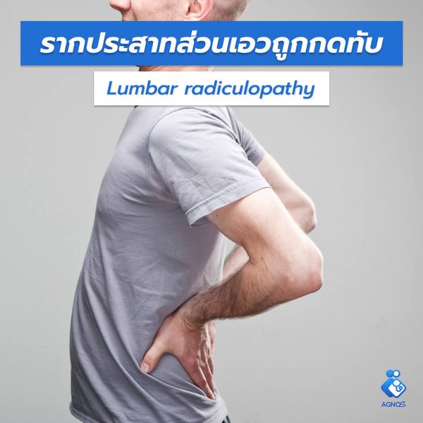 รากประสาทส่วนเอวถูกกดทับ
(Lumbar radiculopathy)