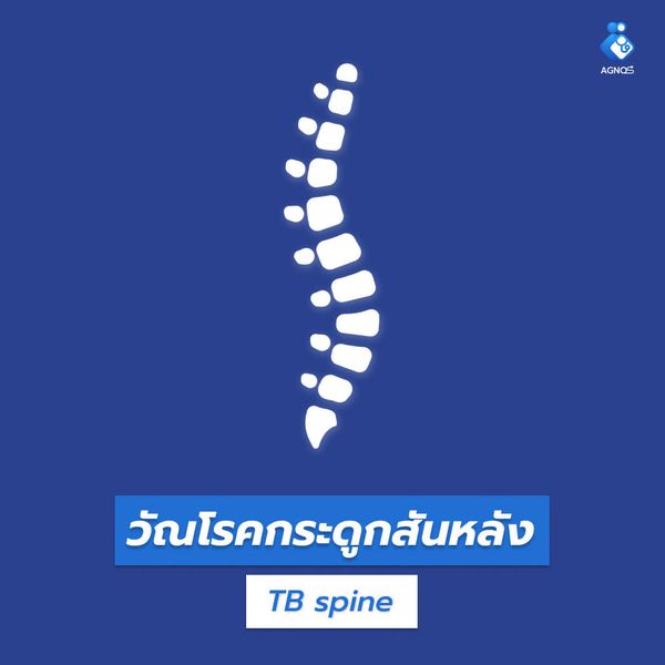วัณโรคกระดูกสันหลัง (TB spine)