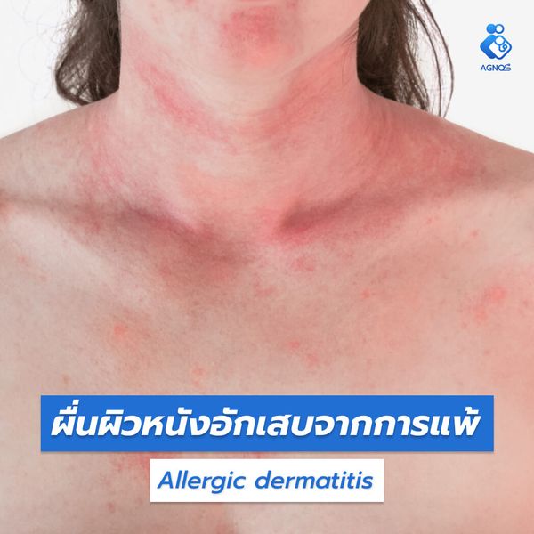 ผื่นผิวหนังอักเสบจากการแพ้
(Allergic dermatitis)