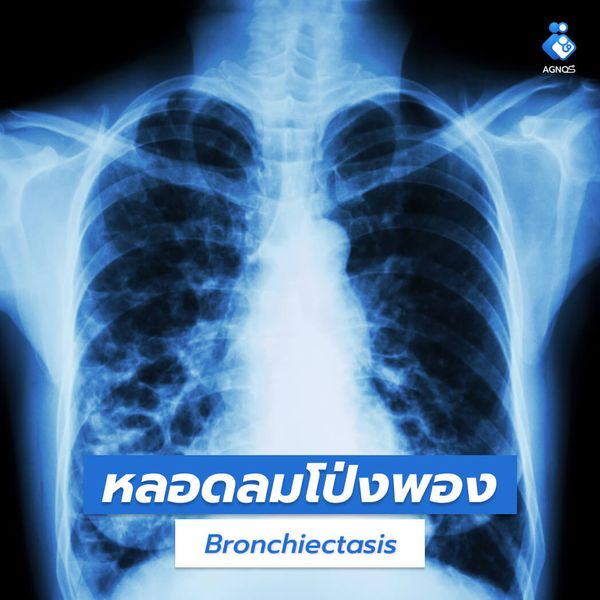 หลอดลมโป่งพอง (Bronchiectasis)
