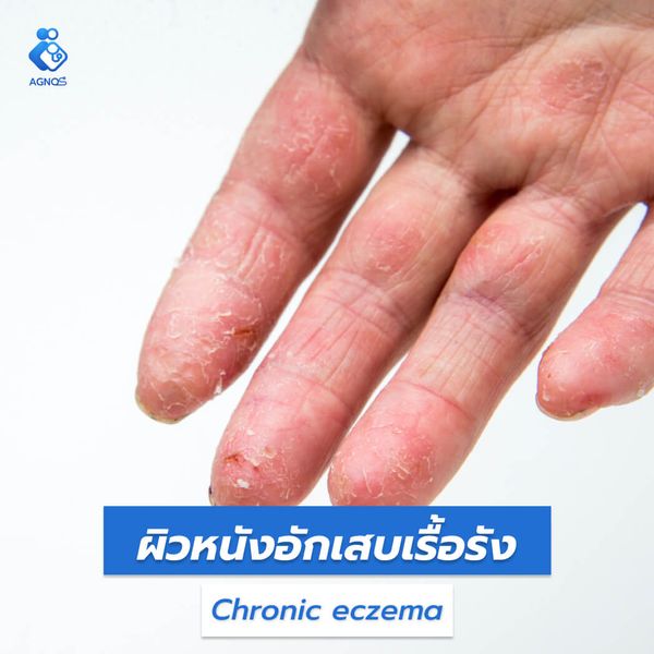 ผิวหนังอักเสบเรื้อรัง (Chronic
eczema)