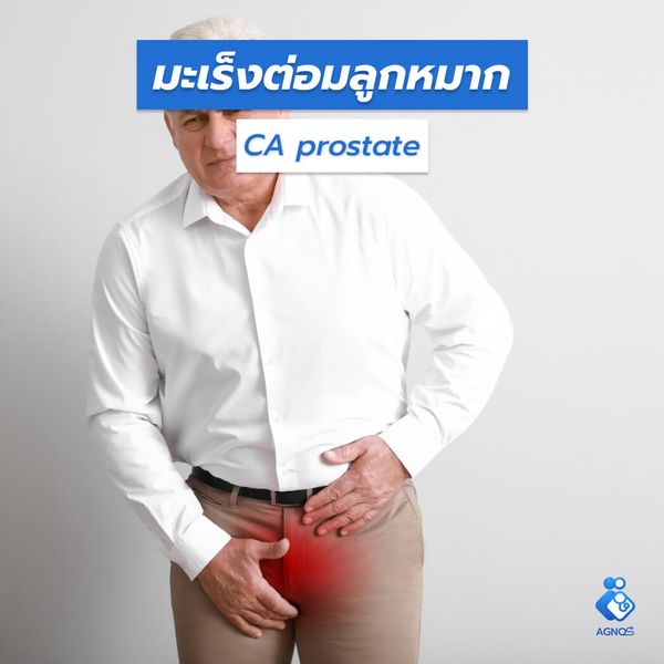 มะเร็งต่อมลูกหมาก (CA prostate)