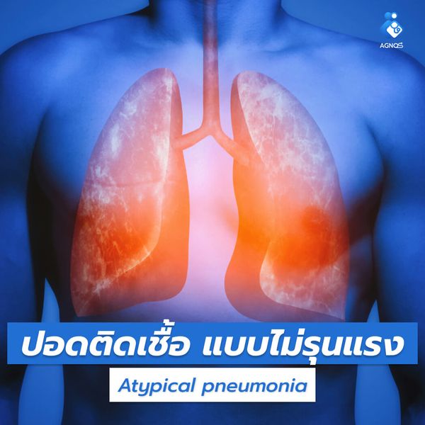 ปอดติดเชื้อ แบบไม่รุนแรง
(Atypical pneumonia)