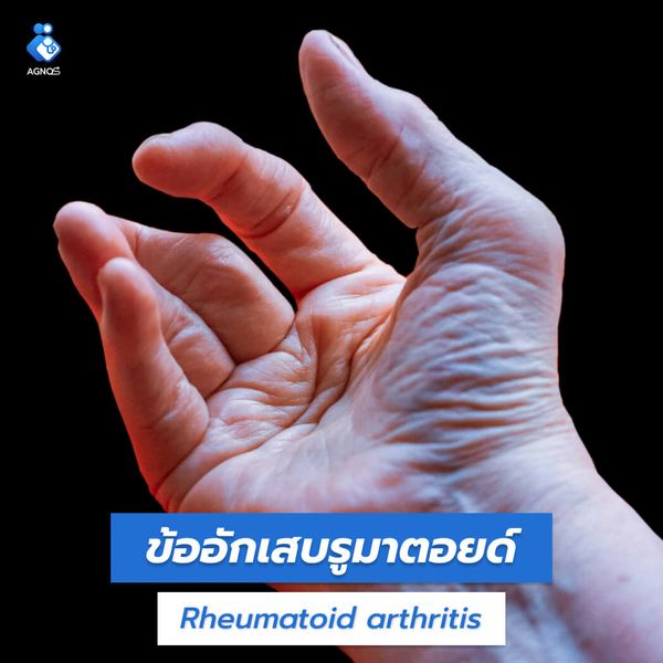 ข้ออักเสบรูมาตอยด์ (Rheumatoid
arthritis)