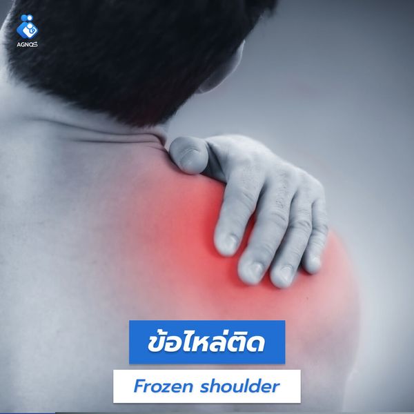 ข้อไหล่ติด (Frozen shoulder)