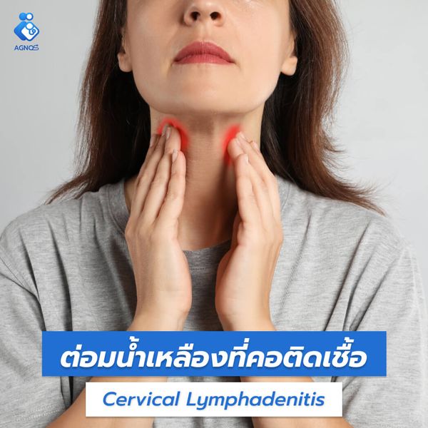 ต่อมน้ำเหลืองที่คอติดเชื้อ
(Cervical Lymphadenitis)