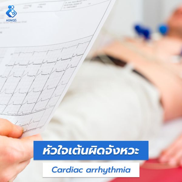 หัวใจเต้นผิดจังหวะ (Cardiac arrhythmia)