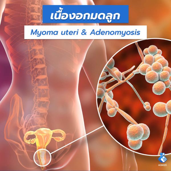 เนื้องอกมดลูก (Myoma uteri & Adenomyosis)