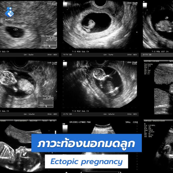 ภาวะท้องนอกมดลูก (Ectopic pregnancy)