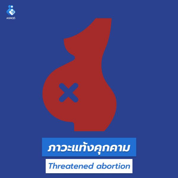 ภาวะแท้งคุกคาม (Threatened abortion)