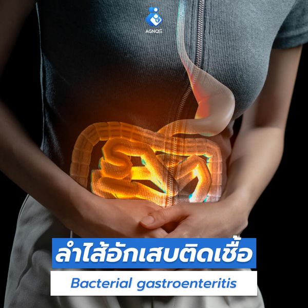 ลำไส้อักเสบติดเชื้อ
(Bacterial gastroenteritis)