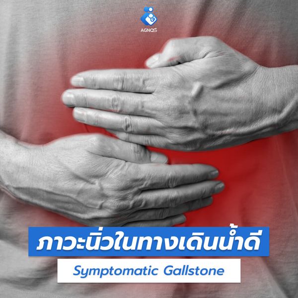 ภาวะนิ่วในทางเดินน้ำดี
(Symptomatic Gallstone)